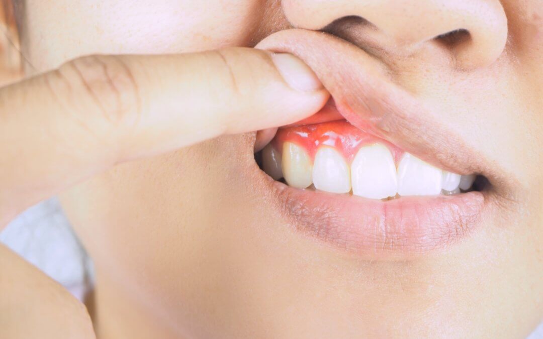 How to Identify, Treat, and Prevent Gingivitis