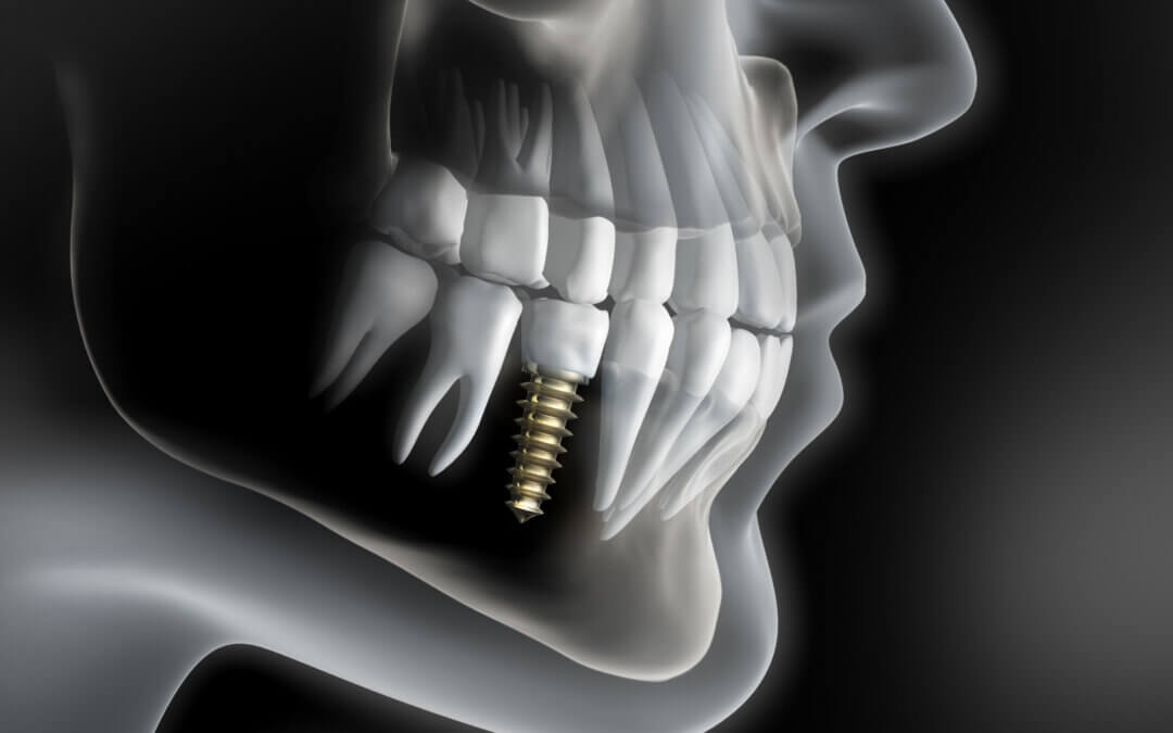 Why Seeing a Georgetown Dentist for Implant Surgery Is the Best Move